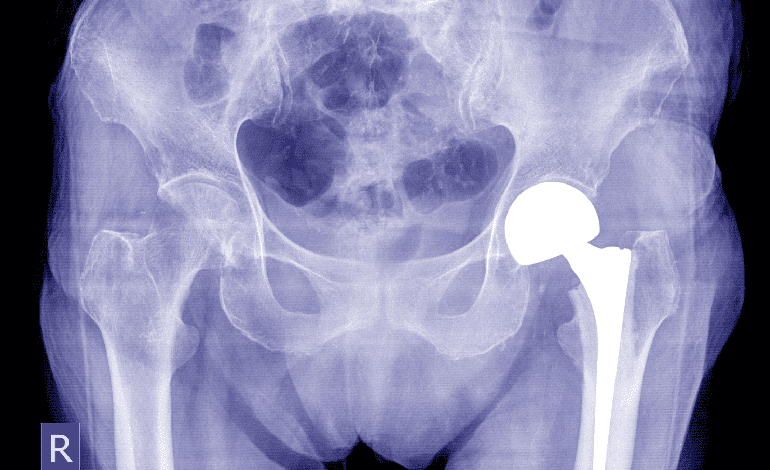 Cirugía de reemplazo articular de cadera en Zapopan: Innovación en Traumatología y Ortopedia
