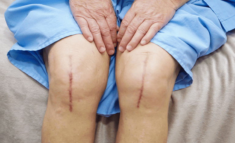 Cirugía de reemplazo articular de rodilla en Zapopan: Solución en Traumatología y ortopedia